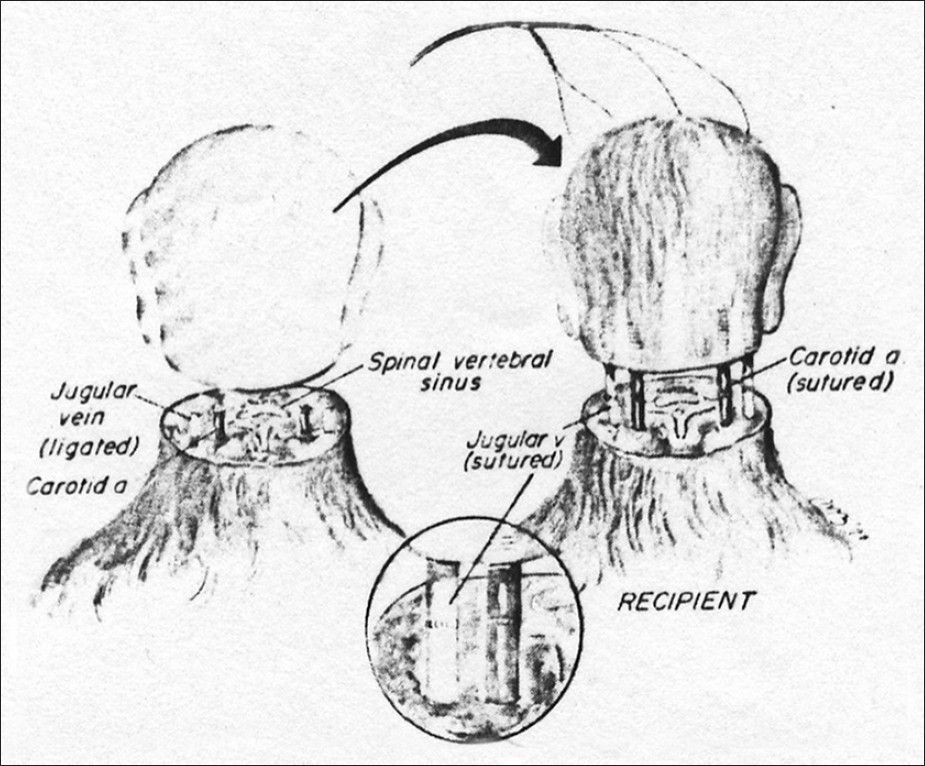 Depiction of the first total cephalosomatic exchange in a monkey (from White et al. 1971)