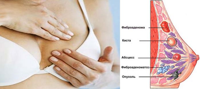 Breast cancer rates in Kazakhstan highest in Central Asia