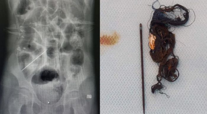 Ақтауда 14 жастағы қыздың ішегінен шаш пен ине табылды 