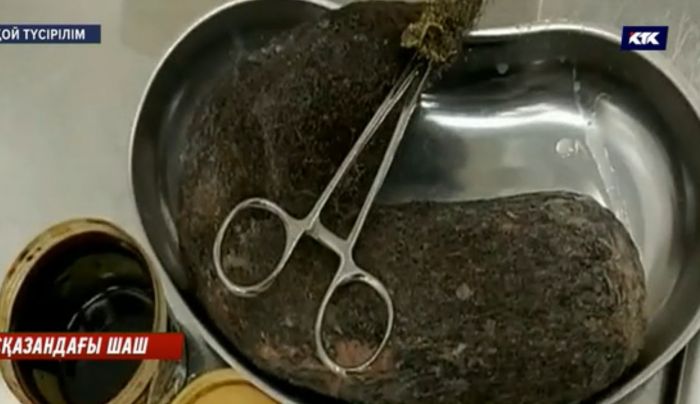 ​Таразда дәрігерлер 13 жасар қыздың асқазанынан бір келі ұйысқан шаш алып шықты