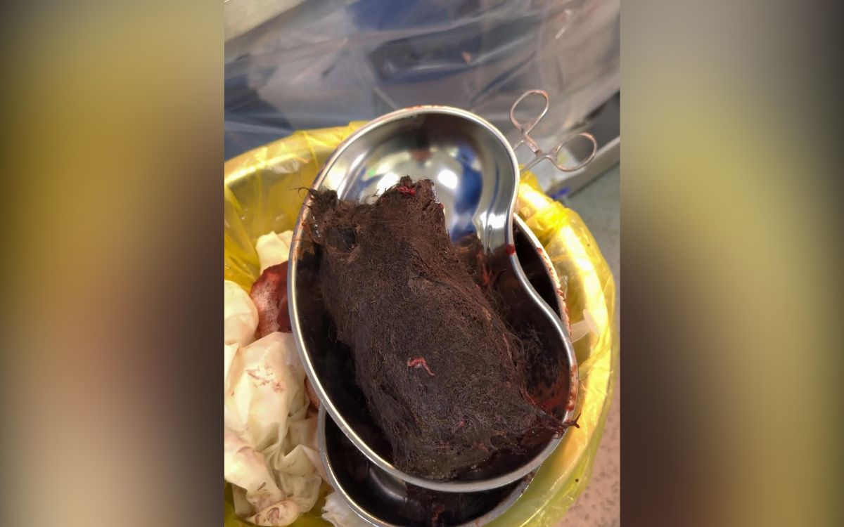 извлеченный трихобезоар, фото управления здравоохранения региона