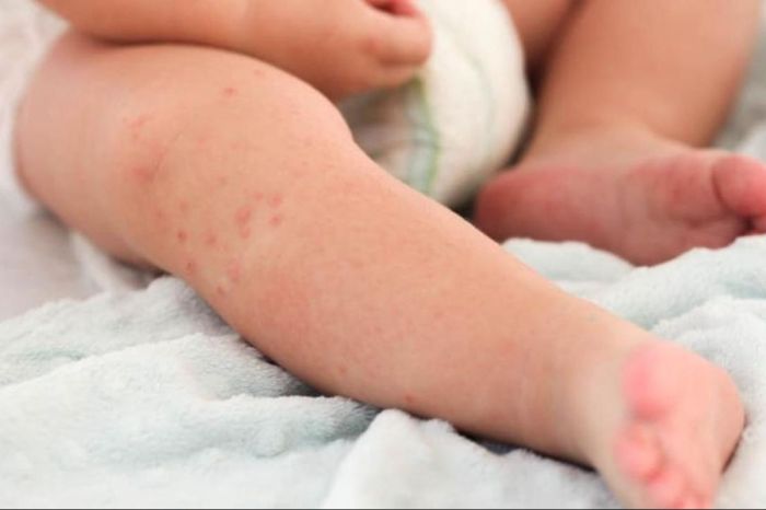 Министр здравоохранения обратилась к казахстанцам с призывом защитить детей от кори