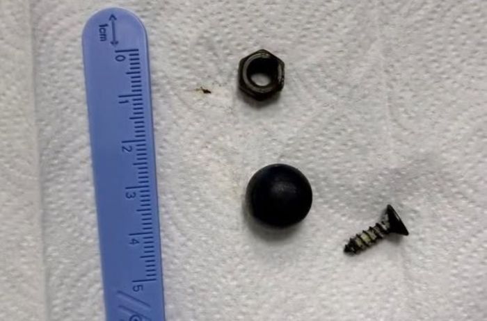 Шестигранная гайка и винт: что нашли хирурги в животе маленького пациента