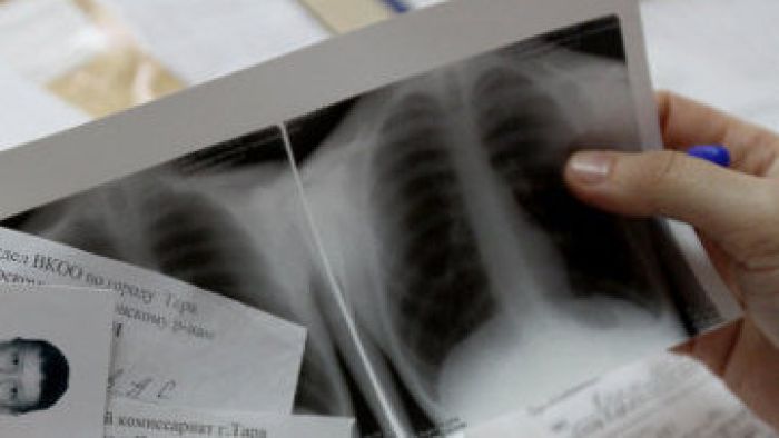 Заболеваемость туберкулезом вдвое снизилась в Казахстане за последние 10 лет
