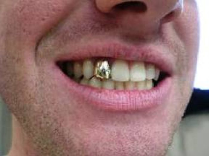 Золотые зубы могут стать проблемой для казахстанцев при выезде за границу