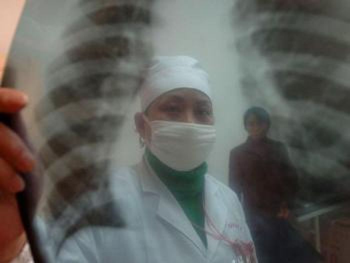 Туберкулёз – беда студентов колледжей