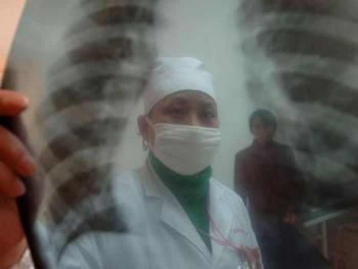 Глава соцучреждения в Туркестане уволен после вспышки туберкулеза