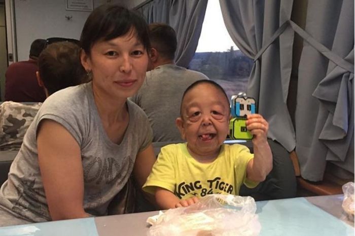 Казахстанскому Бенджамину Баттону сделали операцию в Алматы 