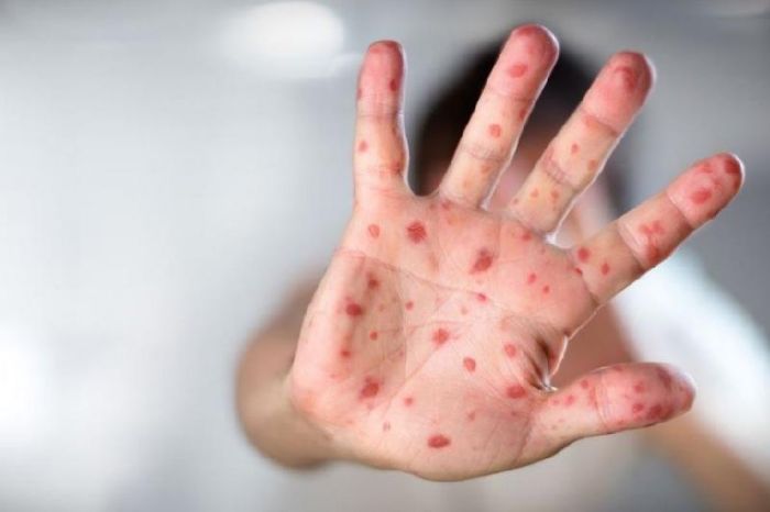 Причины вспышки заболеваемости корью в Казахстане назвали в Минздраве 