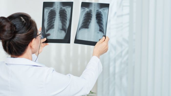 154 человека заболели пневмонией за сутки 