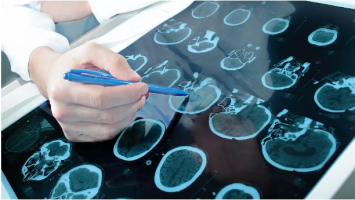 Врач-невролог назвал первые признаки деменции 