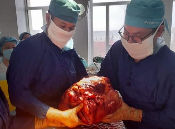 В Атырау врачи удалили у пациента 15-килограммовую опухоль